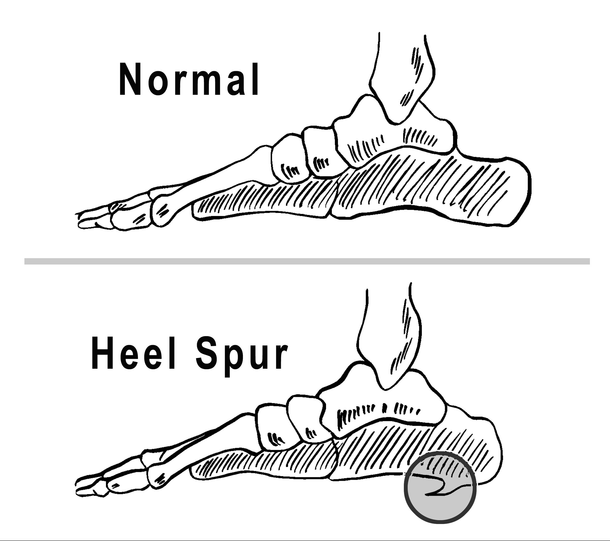 calcaneal spur symptoms mayo clinic