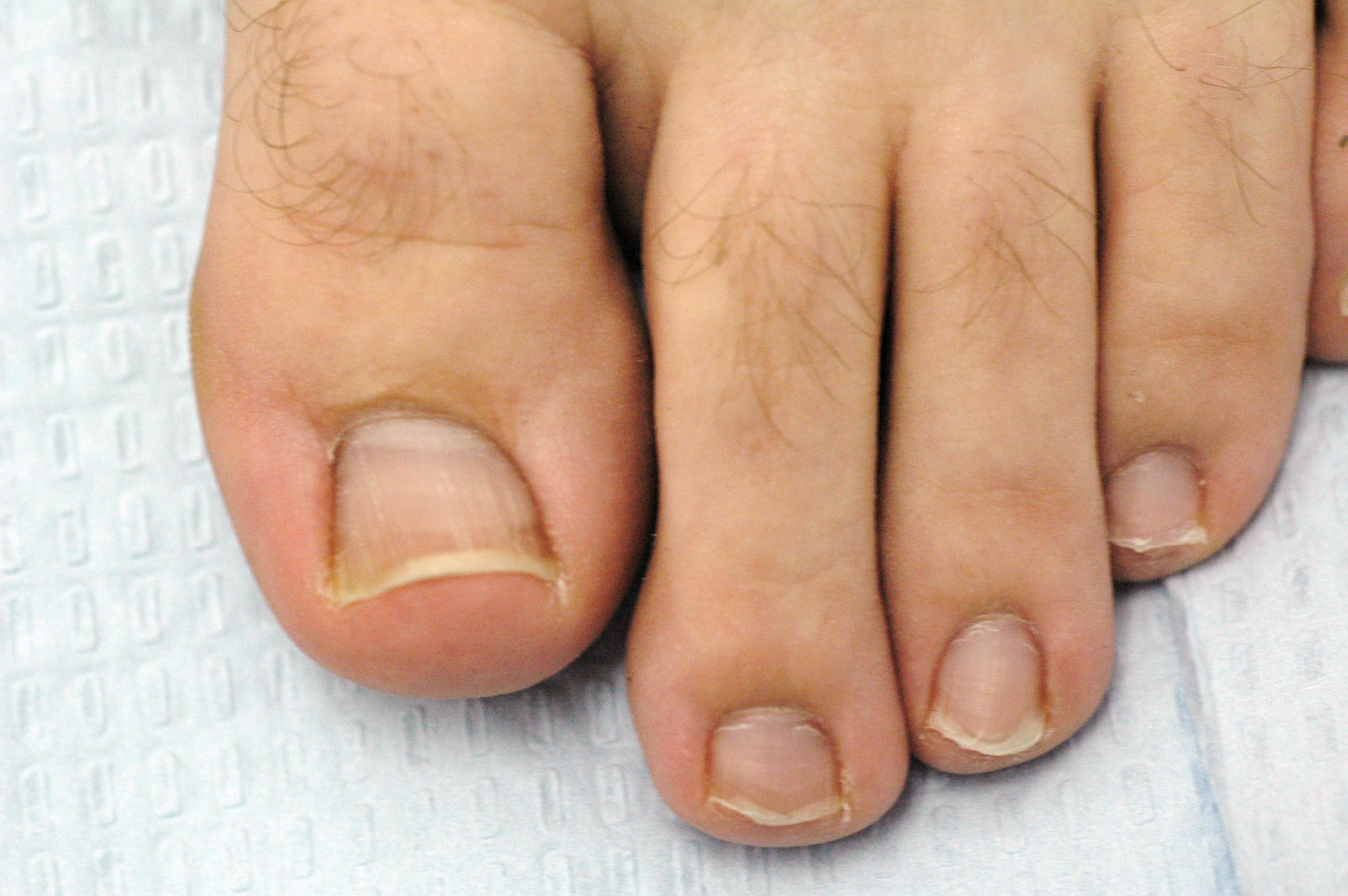 Bunion Misdiagnosis: Health Problems You Can Mistake for Bunions